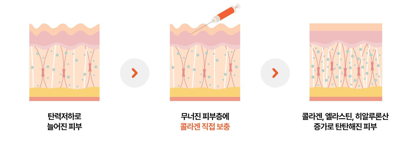 탄력저하로 늘어진피부 > 무너진 피부층에 콜라겐 직접보충 > 콜라겐,엘라스틴,히알루론산 증가로 탄탄해진 피부